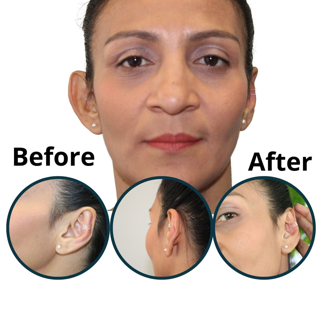 Earcuff Protruding Ears, Big Ears Corrector, Plastic Earrings, Acrylic