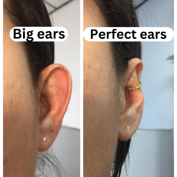 Earcuff voor uitstekende oren