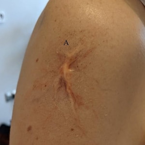 Silicone Burns/Scars Prosthetics