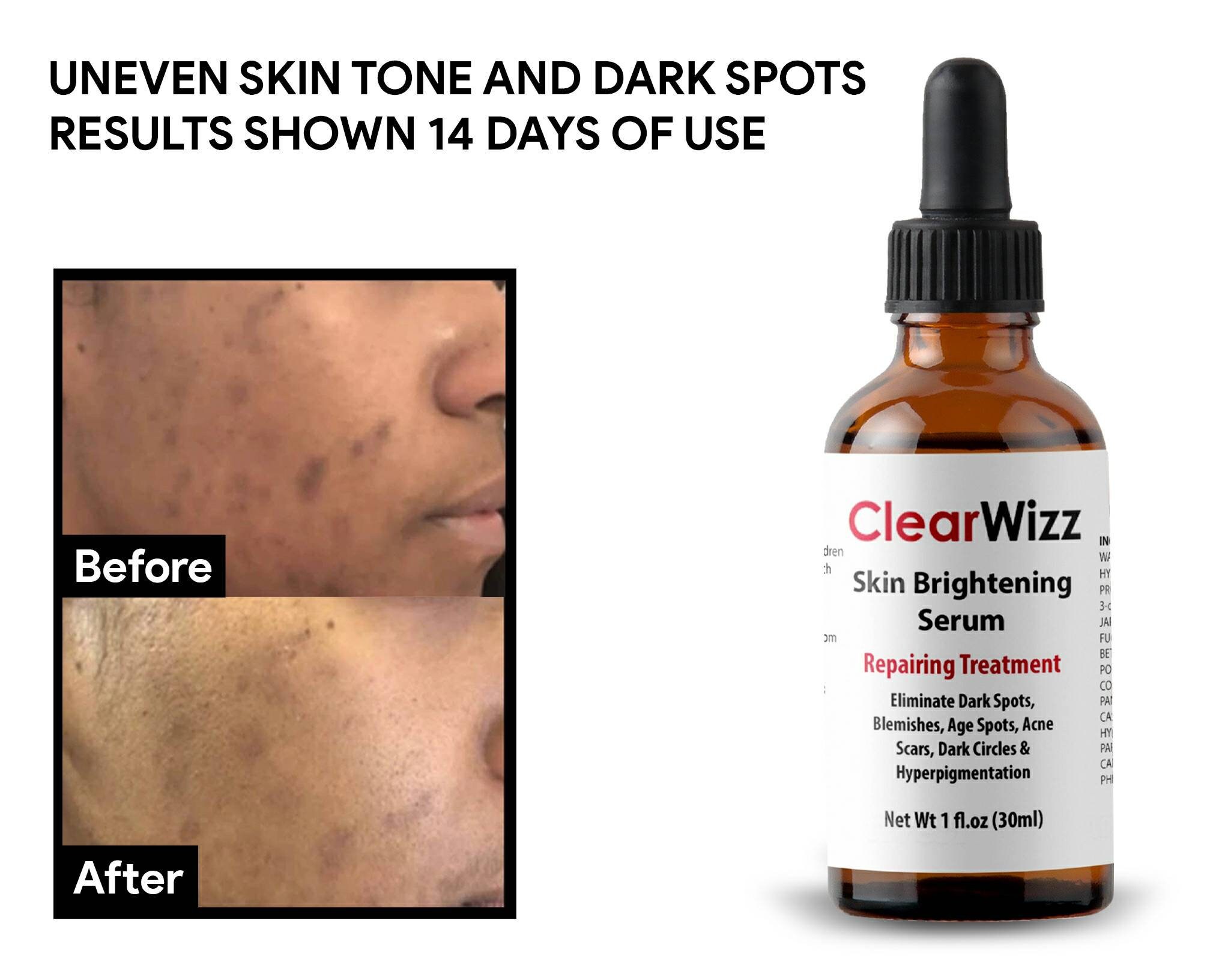 1 oz Dark Spot Corrector Whitening Serum Blemishes Etsy