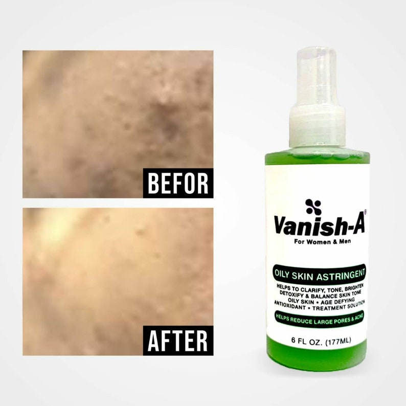 6 Fl Oz Oily Skin Astringent Zero Spot Toner Oily Skin Etsy