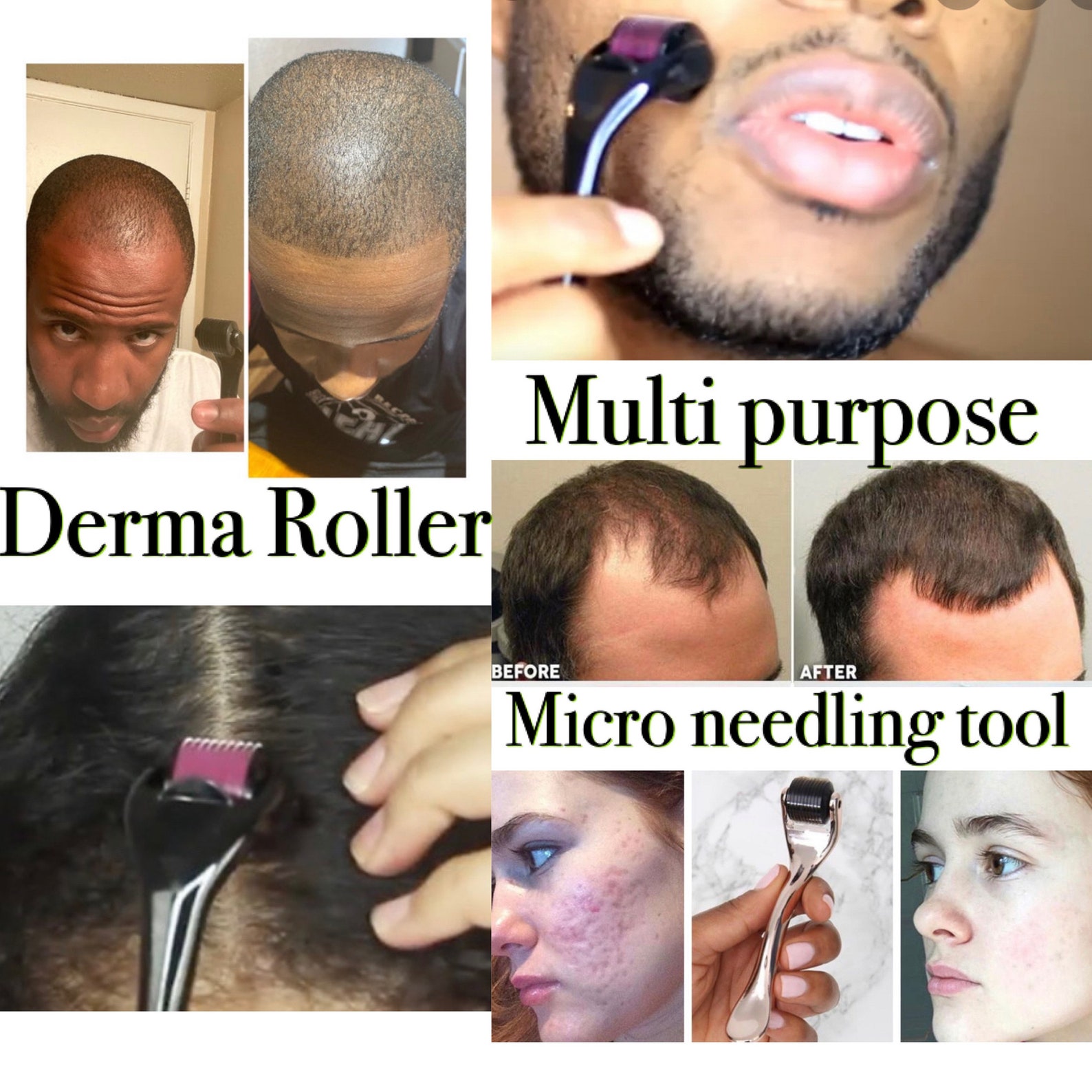 0.5 derma roller for hair growth