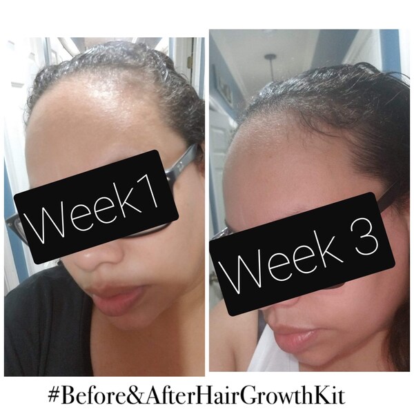 Alopecia Hair Growth Etsy