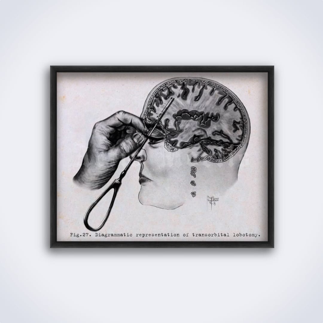 Transorbital Lobotomy Medical Illustration. Brain, Neurology