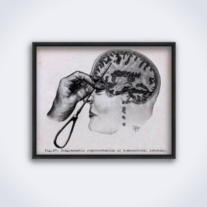 Transorbital lobotomy medical illustration. Brain, neurology, psychosurgery, surgery, psychiatry – vintage print, poster (DIGITAL DOWNLOAD)