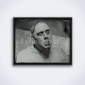 Psychosurgery victim medical photo. Trepanning, lobotomy, brain, neurology, mental hospital, vintage print, poster (DIGITAL DOWNLOAD)