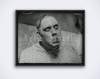 Psychosurgery victim medical photo. Trepanning, lobotomy, brain, neurology, mental hospital, vintage print, poster (DIGITAL DOWNLOAD)