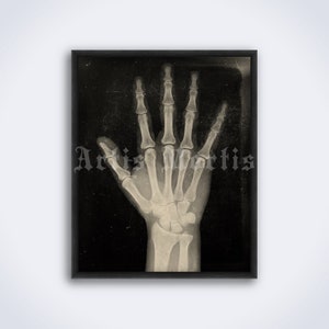 May include: Black and white vintage x-ray image of a human hand. The image is framed in a black frame.