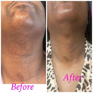 May include: Before and after photos showing the results of a treatment on a person's neck. The before photo shows dark spots and hair on the neck. The after photo shows a smoother, clearer neck with less hair. The text "Before" is written below the before photo and the text "After" is written below the after photo.