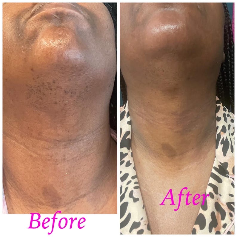 May include: Before and after photos showing the results of a treatment on a person's neck. The before photo shows dark spots and hair on the neck. The after photo shows a smoother, clearer neck with less hair. The text "Before" is written below the before photo and the text "After" is written below the after photo.