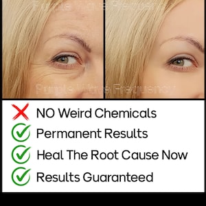 May include: Before and after image showing the effectiveness of a product. The image on the left shows wrinkles around the eyes. The image on the right shows smoother skin. Text on the image reads: "NO Weird Chemicals", "Permanent Results", "Heal The Root Cause Now", "Results Guaranteed".