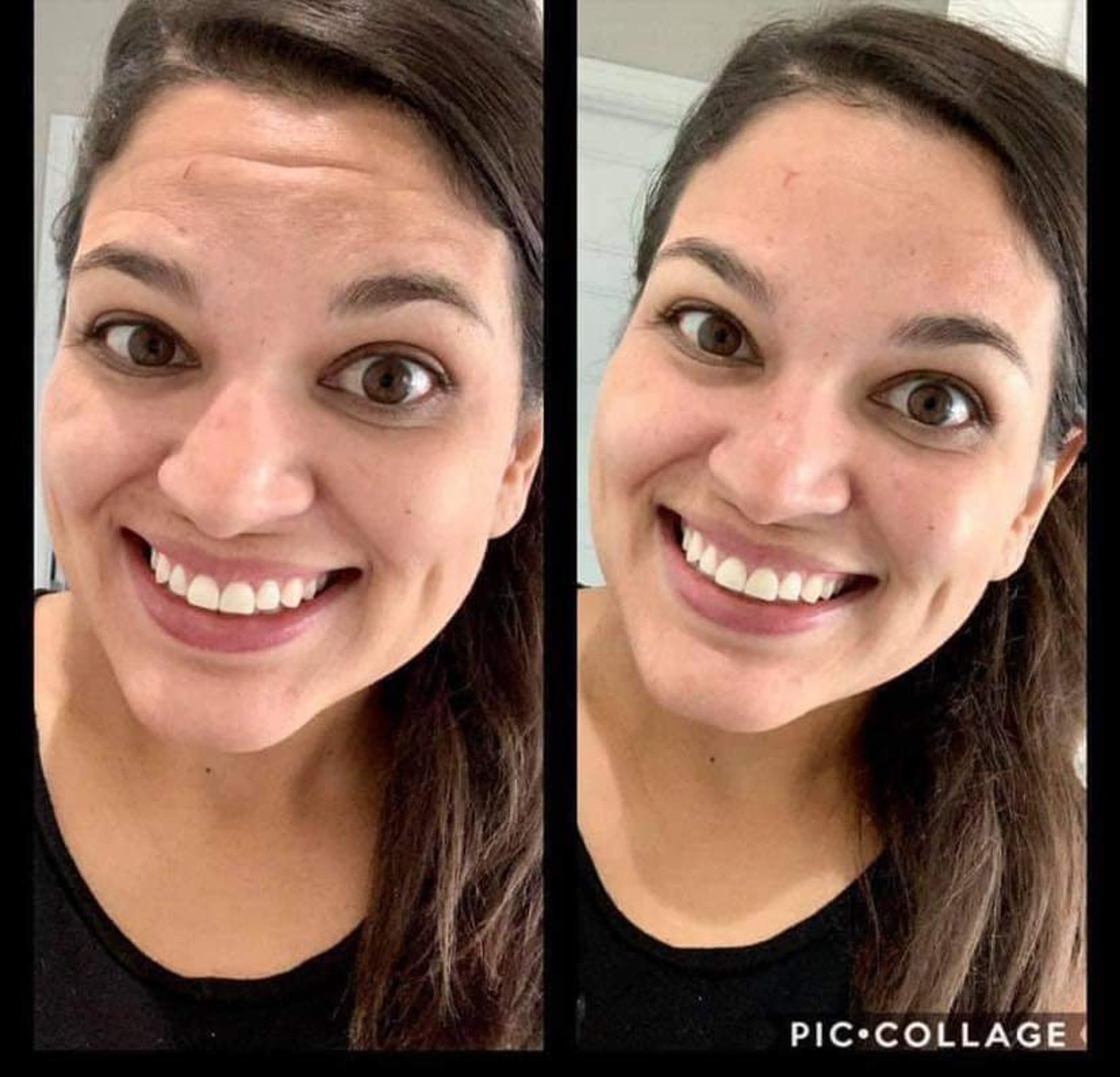 Face lift botox in a bottle instant face lift wrinkle etsy