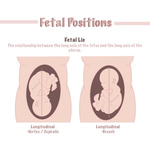 Könnte beinhalten: Illustration von zwei Fetalpositionen im Mutterleib. Die erste zeigt ein Baby in longitudinaler Position mit dem Kopf nach unten, beschriftet "Vertex/Kopf". Die zweite zeigt ein Baby in longitudinaler Position mit den Füßen nach unten, beschriftet "Steißlage".