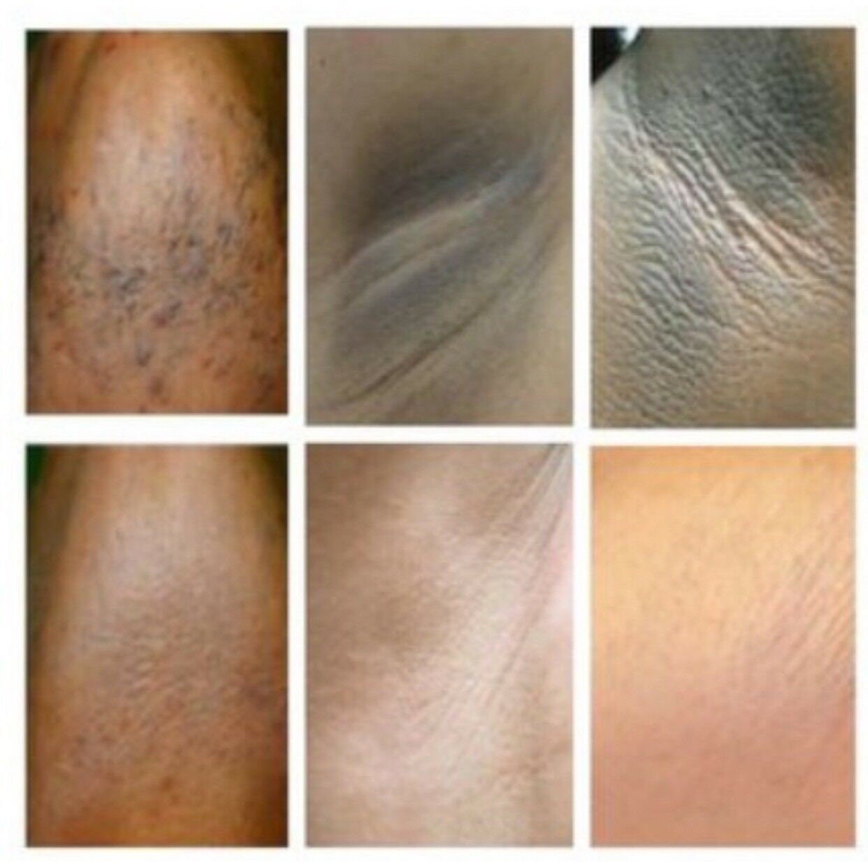 How to Use Lightening Cream Products: Fade Skin Blemishes & Scars - Bellatory