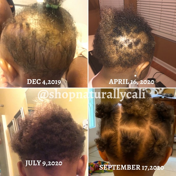 Sample Hair Growth Oil 1 2 Oz Bottle Itchy Baby Scalp Baby Etsy Sample Hair Growth Oil 1 2 Oz Bottle Itchy Baby Scalp Baby Etsy