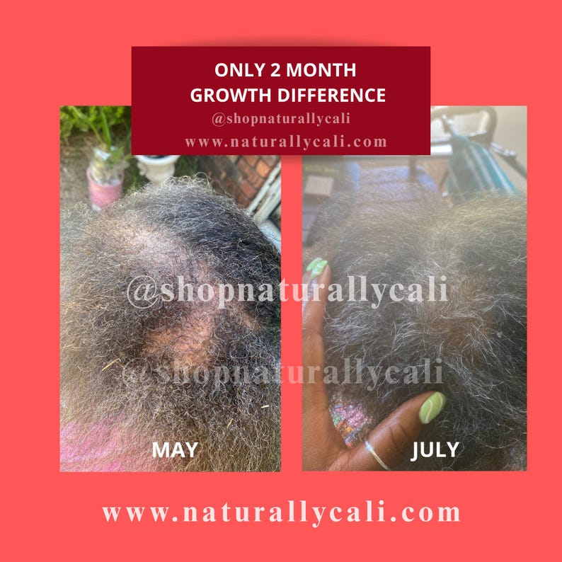 K&ouml;nnte beinhalten: Bild zeigt zwei Fotos einer Kopfhaut, die das Haarwachstum &uuml;ber zwei Monate hinweg veranschaulichen. Der Text lautet "ONLY 2 MONTH GROWTH DIFFERENCE" und enth&auml;lt eine Website-Adresse.