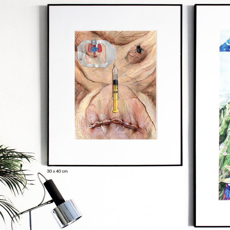 May include: A watercolor painting of a human face with a stitched-up mouth, a fly, and a syringe with a yellow needle. The face is depicted as a close-up, with the stitches and fly being the main focus. The painting is framed in black and has a white mat.