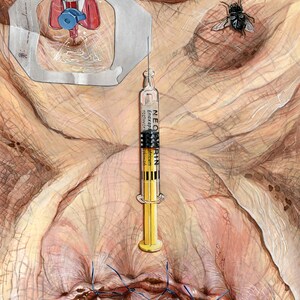 May include: A close-up of a medical illustration depicting a surgical procedure. A syringe labeled "NEOCORTIN" is positioned above a stitched wound. A fly is perched on the skin, and a medical device with a red and blue component is visible in the upper left corner.
