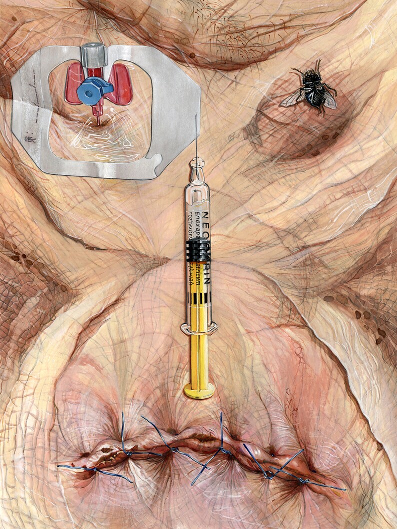 May include: A close-up of a medical illustration depicting a surgical procedure. A syringe labeled "NEOCORTIN" is positioned above a stitched wound. A fly is perched on the skin, and a medical device with a red and blue component is visible in the upper left corner.