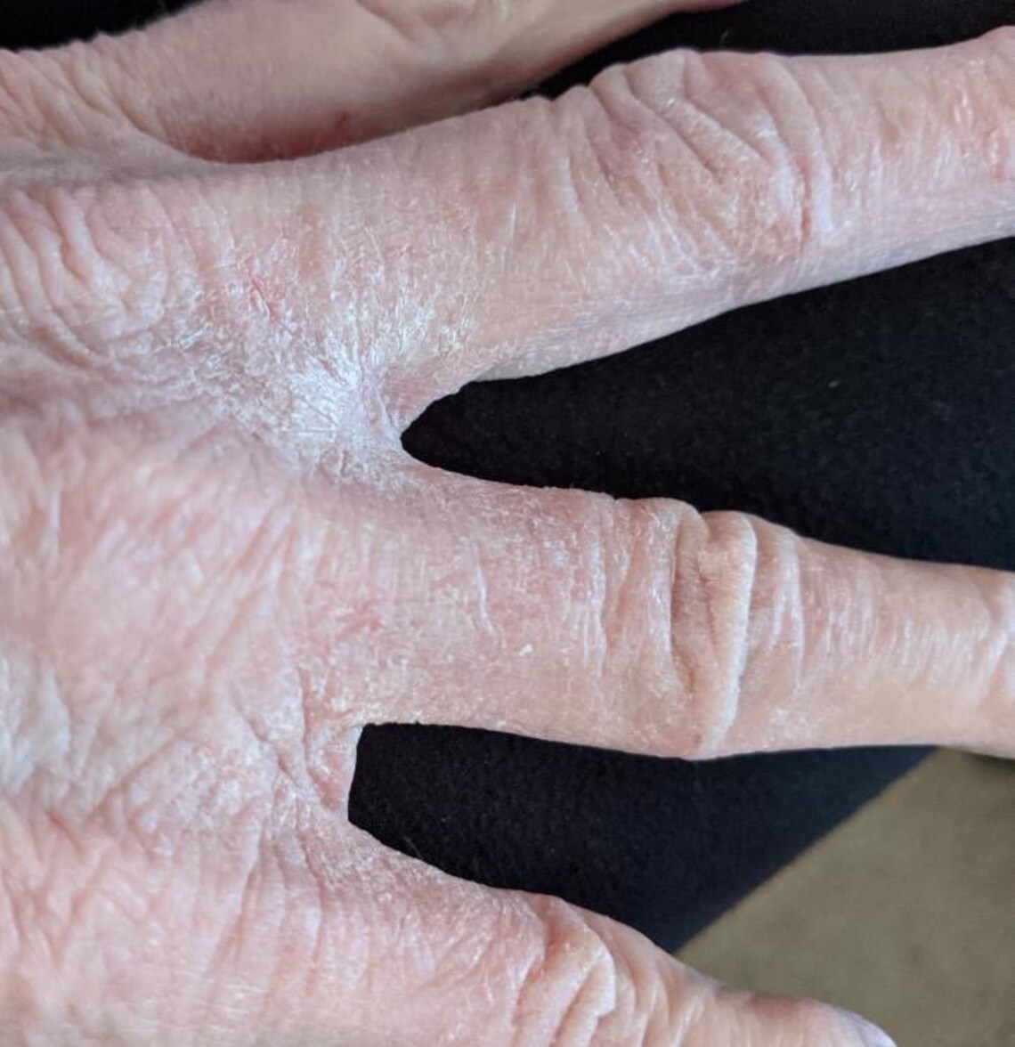 Eczema relief bar soap homemade soap soap eczema psoriasis Etsy