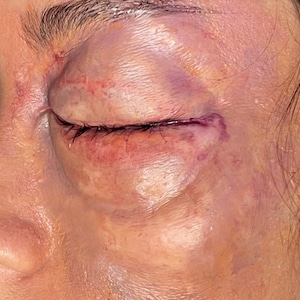 SWOLLEN EYE PROSTHETICS /Halloween/cosplay/silicone/sfxmakeup/cinema/TV/zombie