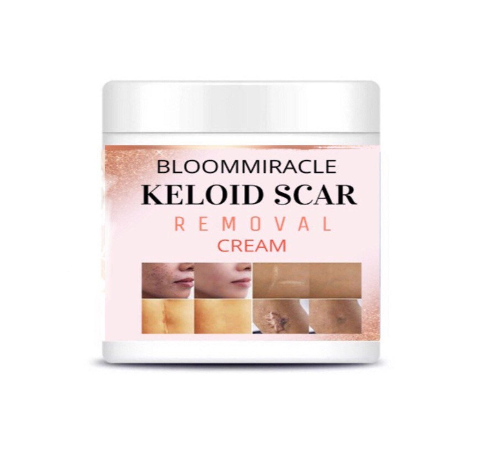 KELOID REMOVAL Etsy