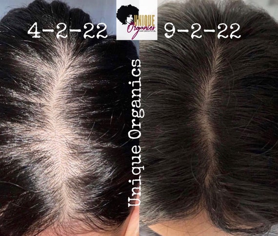 DHT Blocker Male Female Pattern Baldness Hair Oil - Etsy