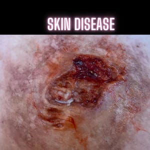 Skin Disease Wound 2 | SFX Make Up | Silicone Prosthetic