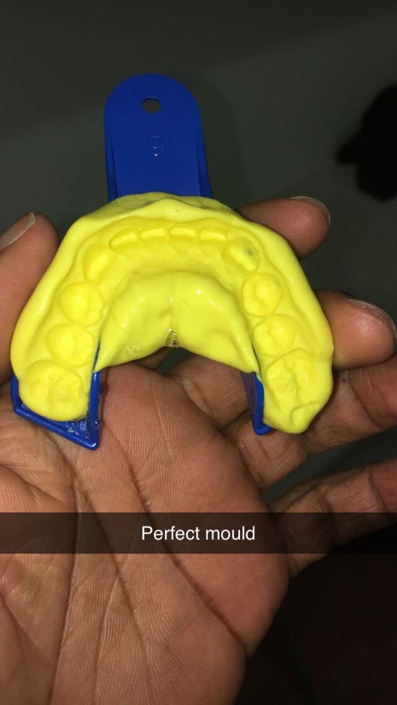 Dental impression moulding kit Etsy