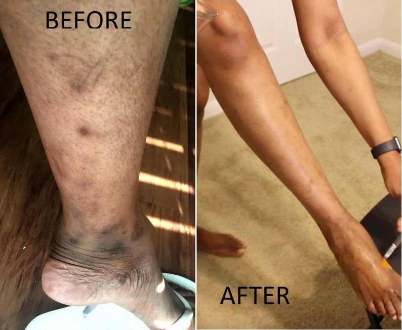 TCA 25 BUY1GET1FREE FREE SHIPPING Chemical Peelexfoliate Acne Scars