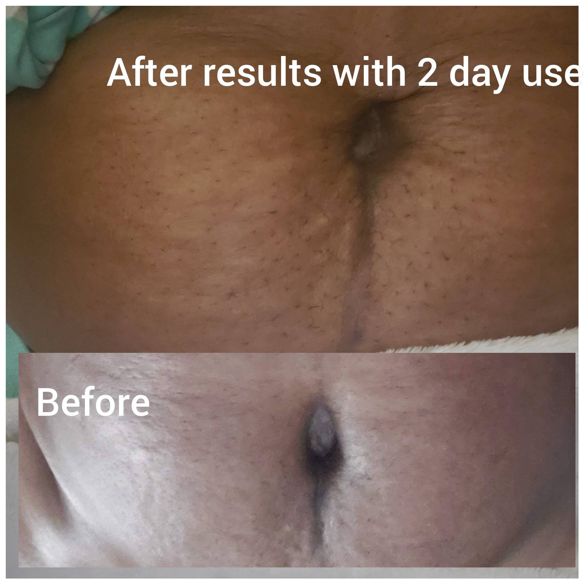 Flylisious all natural stretch marks and cellulite removal ,cream fad…