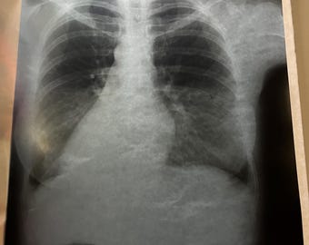 X Ray Slides 5 LUNGS Ribcage Decor use for Cyanotypes Screen Printing Shade Craft Xray