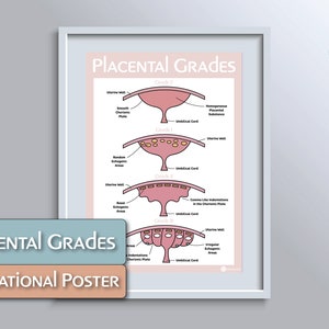 Placenta Grading Educational Poster