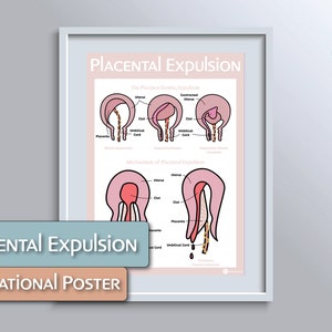 Placental Expulsion Educational Poster