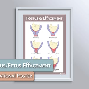 Foetus/Fetus and Effacement Educational Poster
