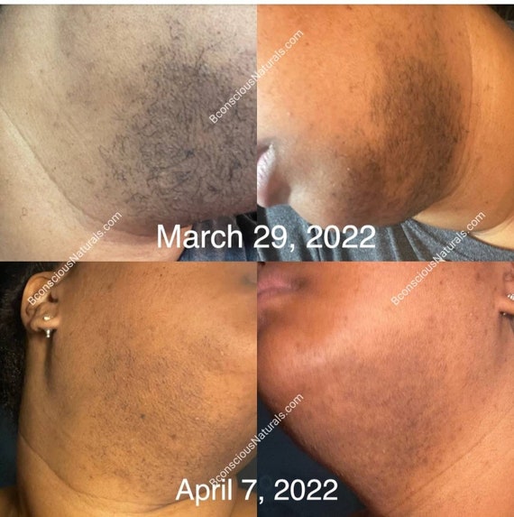 Hair Removalfacial Hair Removalnatural Hair Removalhair - Etsy Hair Removalfacial Hair Removalnatural Hair Removalhair - Etsy