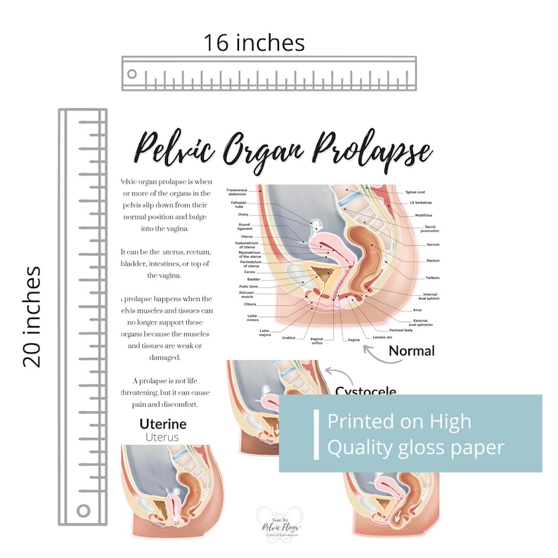 Prolapzo Prolapse Definition Art Print of Bladder, Rectum, & Uterus | Cystocele ...
