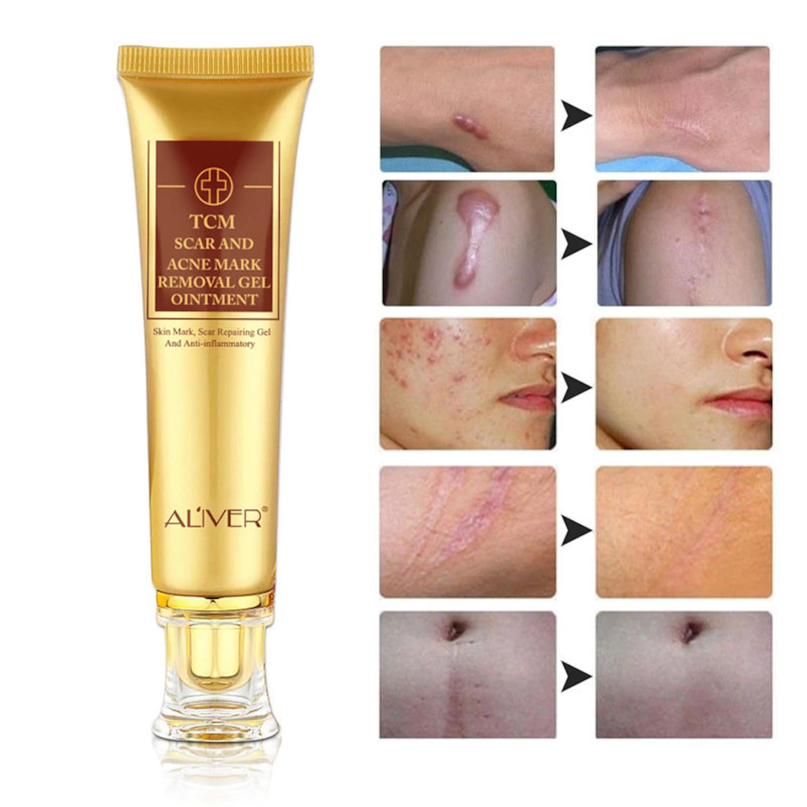 Scar Cream Aliver Strench Mark & Acne Spot Removal Cream for | Etsy