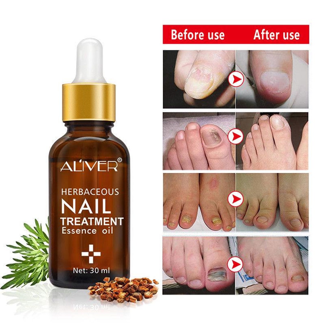 Herbaceous Nail Treatment Essence Natural AntiFungal Nail Etsy