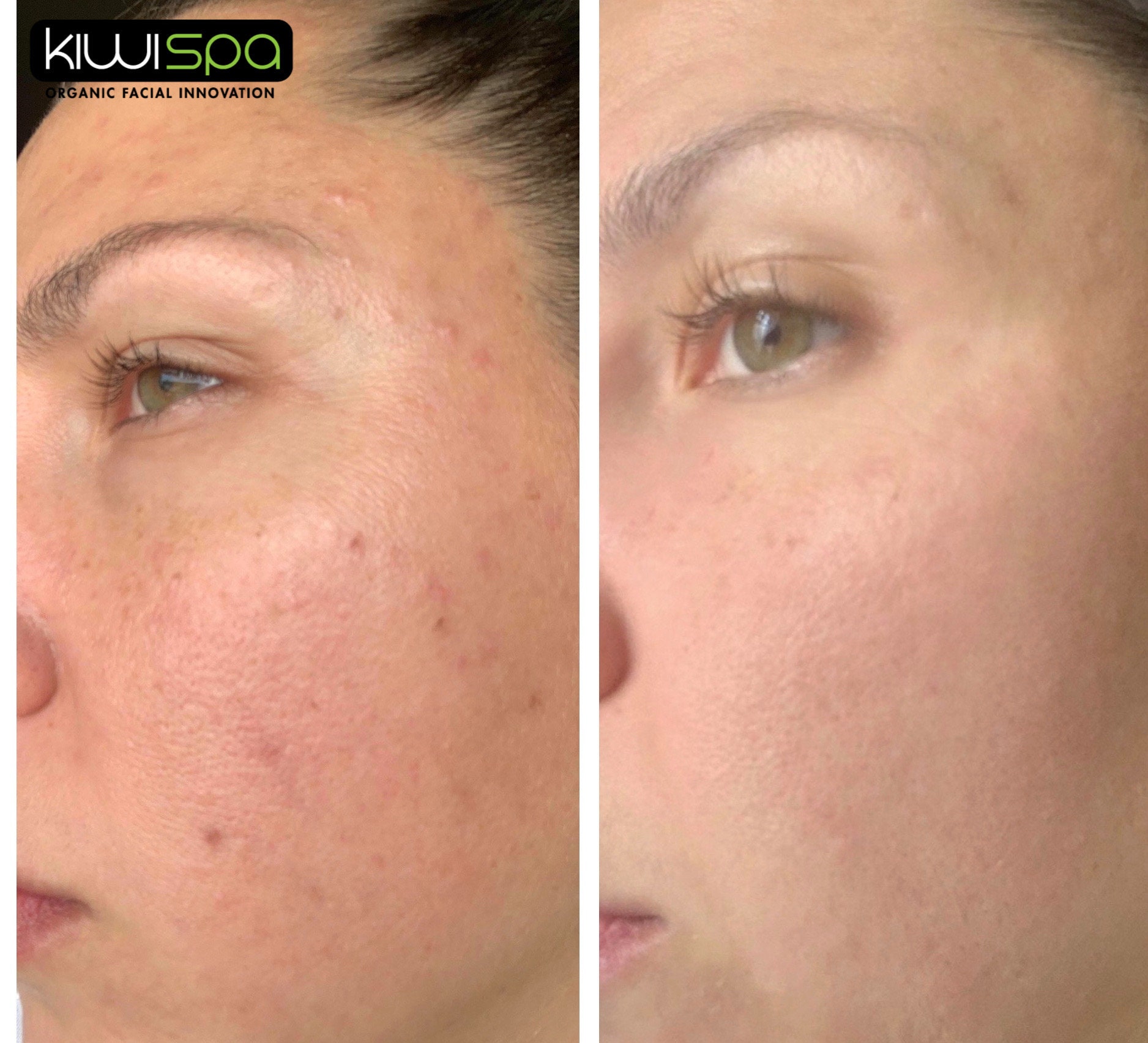 Natural Face Mask Pumpkin Enzyme Peel Face Scrub Skin Care Etsy UK