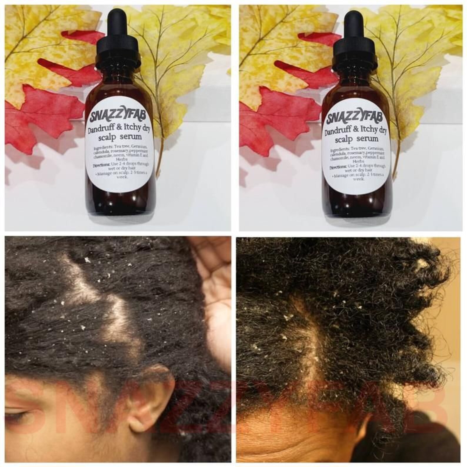 Scalp Detox oil dandruff oil scalp treatment for psoriasis Etsy