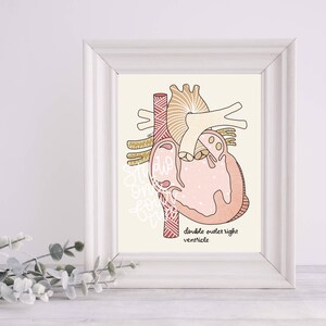 DORV Art Print | CHD Art Print | Physical Print | Heart Defect Illustration Print