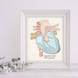HRHS Art Print | Hypoplastic Right Heart Syndrome | CHD Art Print | Physical Print | Heart Defect Illustration Print