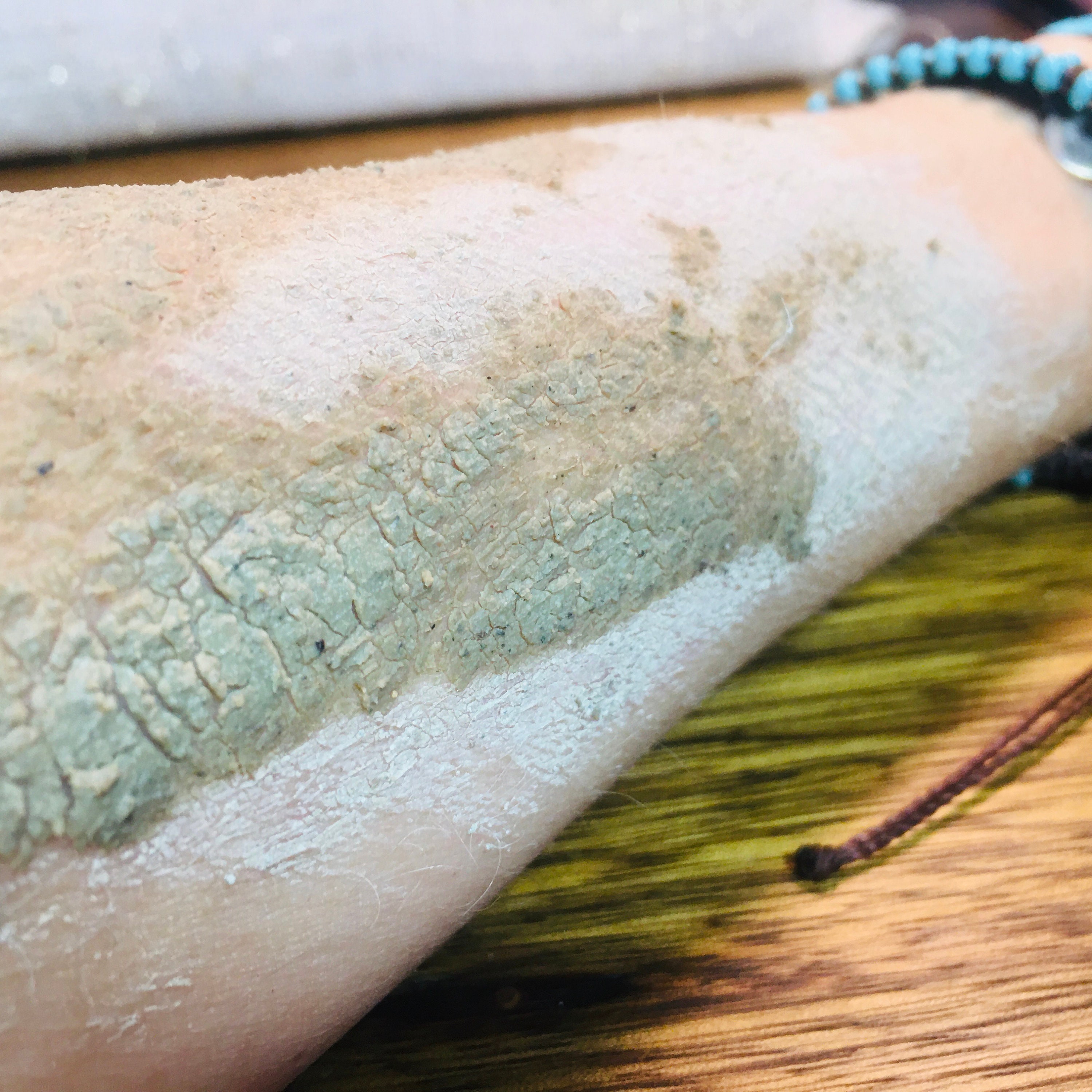 Acne Pimples PizzaFace 2 phase treatment. Curative anti Etsy