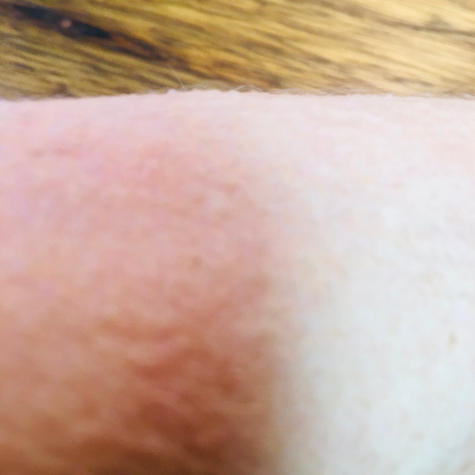 Acne Pimples PizzaFace 2 phase treatment. Curative anti Etsy