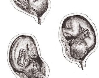 Placenta Previa Illustrations Set of Two: Birth/Doula/Midwife Art Printable