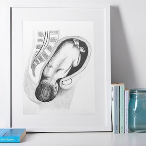 Shoulder Dystocia Print