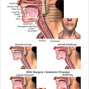 May include: A medical illustration showing the anatomy of the human throat and larynx, with labels for the different parts. The illustration shows the normal anatomy of the throat and larynx, as well as the changes that occur after a laryngectomy. The illustration also shows how a person breathes and speaks after a laryngectomy.