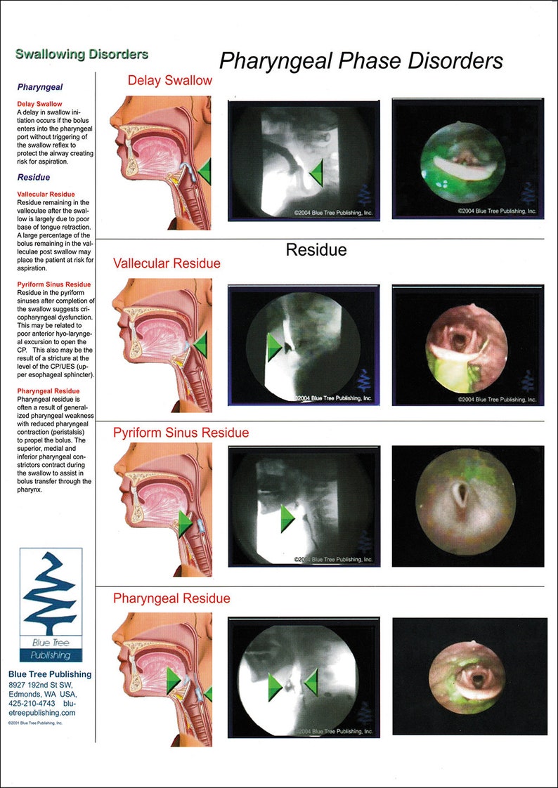 Swallowing Disorders Anatomical Chart - Etsy