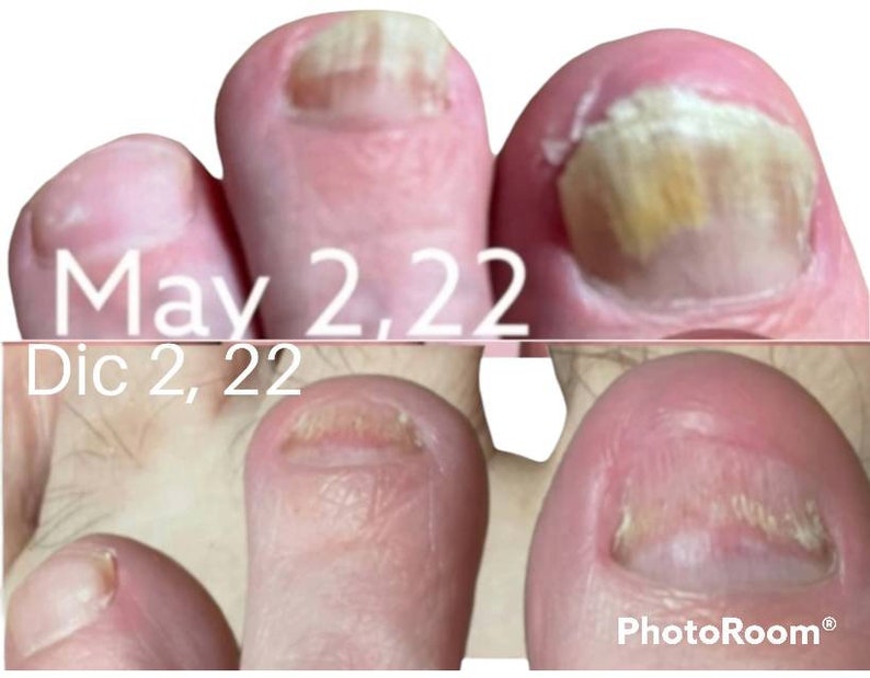 Fungb Gone a Homeopathic Antifungal Solution for the Treatment of Nail